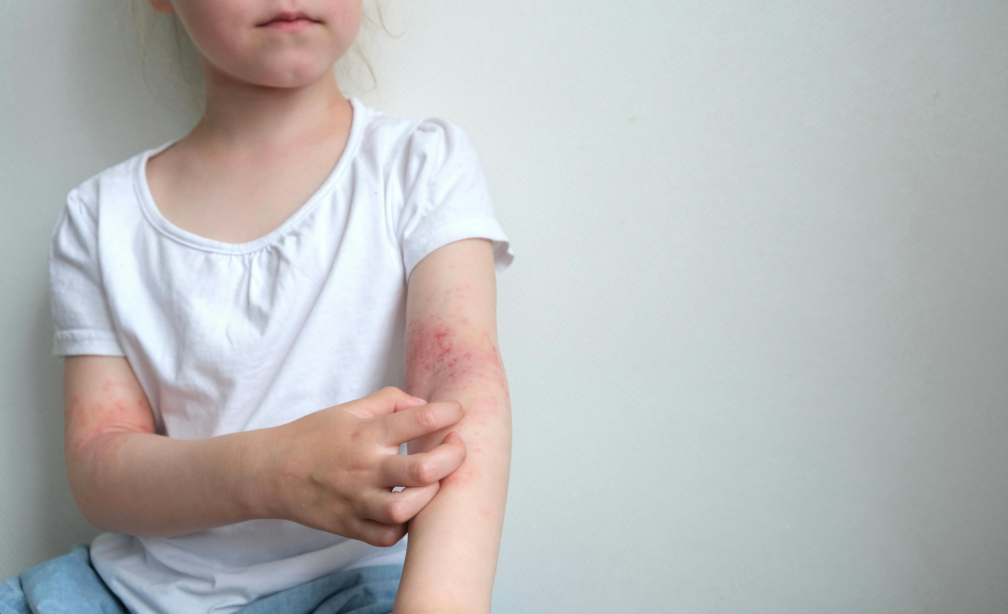 Child itches atopic dermatitis on skin Image credit: © Марина Терехова - © Марина Терехова - stock.adobe.com