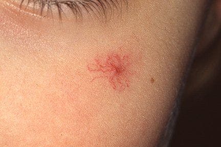 Spider angioma is a benign vascular malformation often found on the face, forearms, and hands.