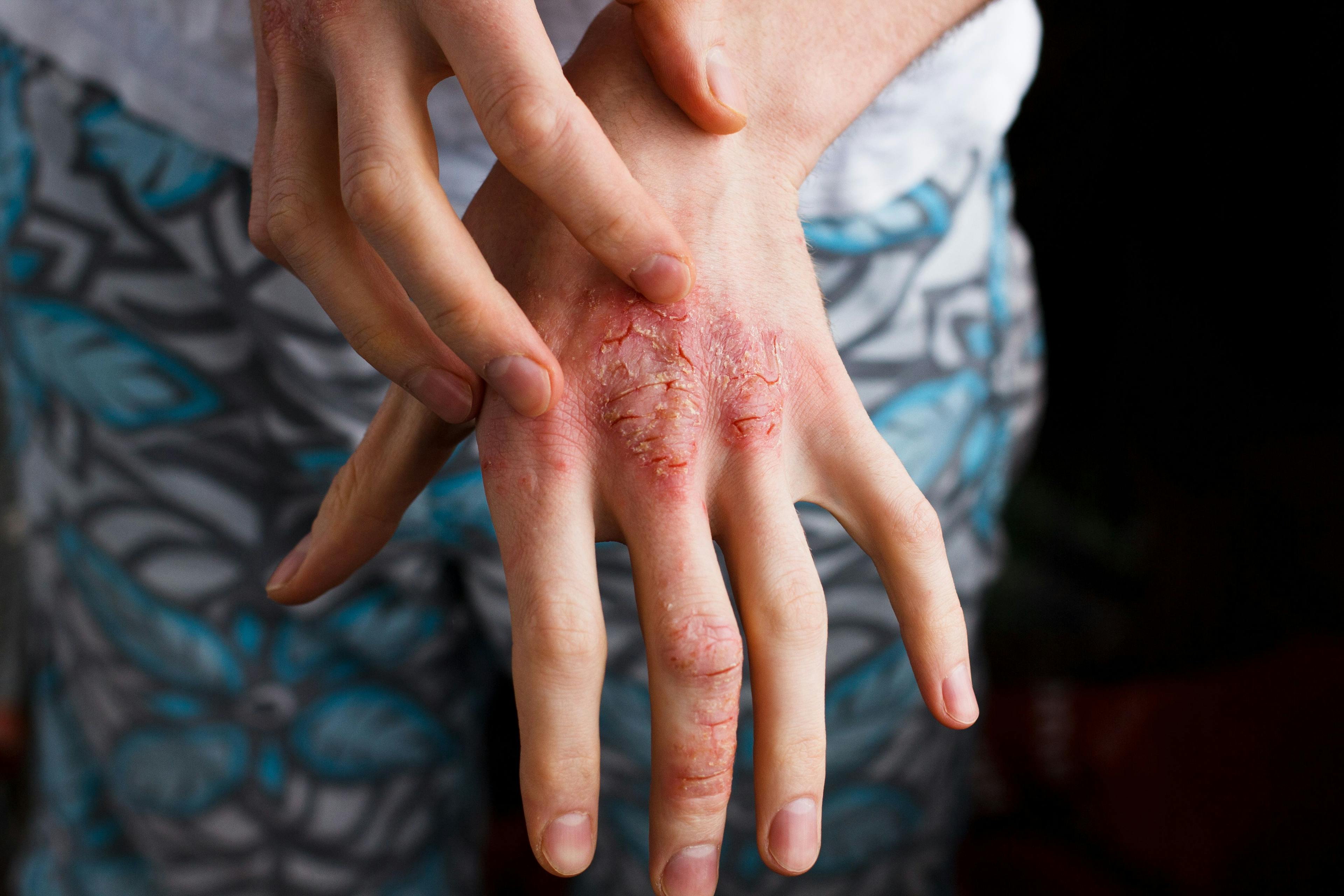 Apremilast may significantly, safely benefit severe pediatric psoriasis