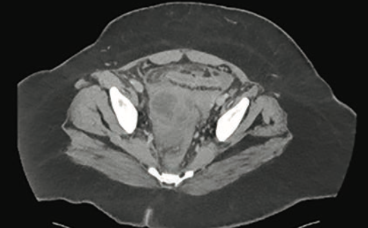 CT abdomen/pelvis with and without contrast demonstrates large tubo-ovarian abscess