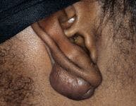 Figure: Scar tissue originating from the ear lobe.