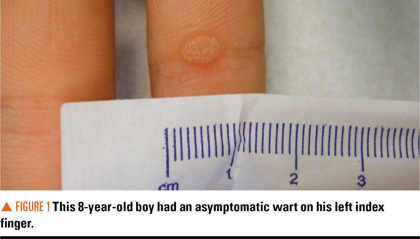 Boy with asymptomatic wart on left hand