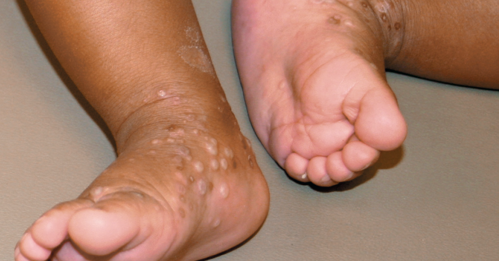 Infant’s pustular eruption is not scabies