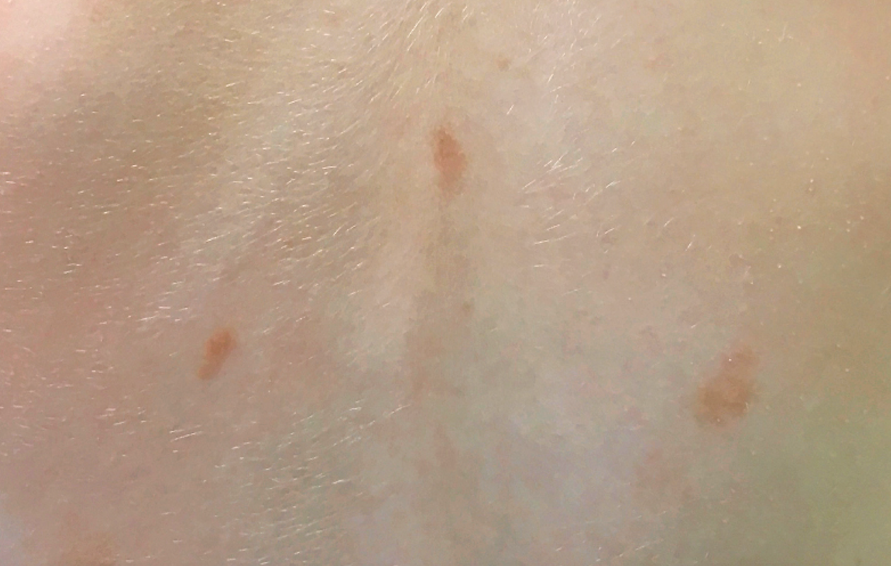 Fuzzy brown spots on a healthy 3-year-old