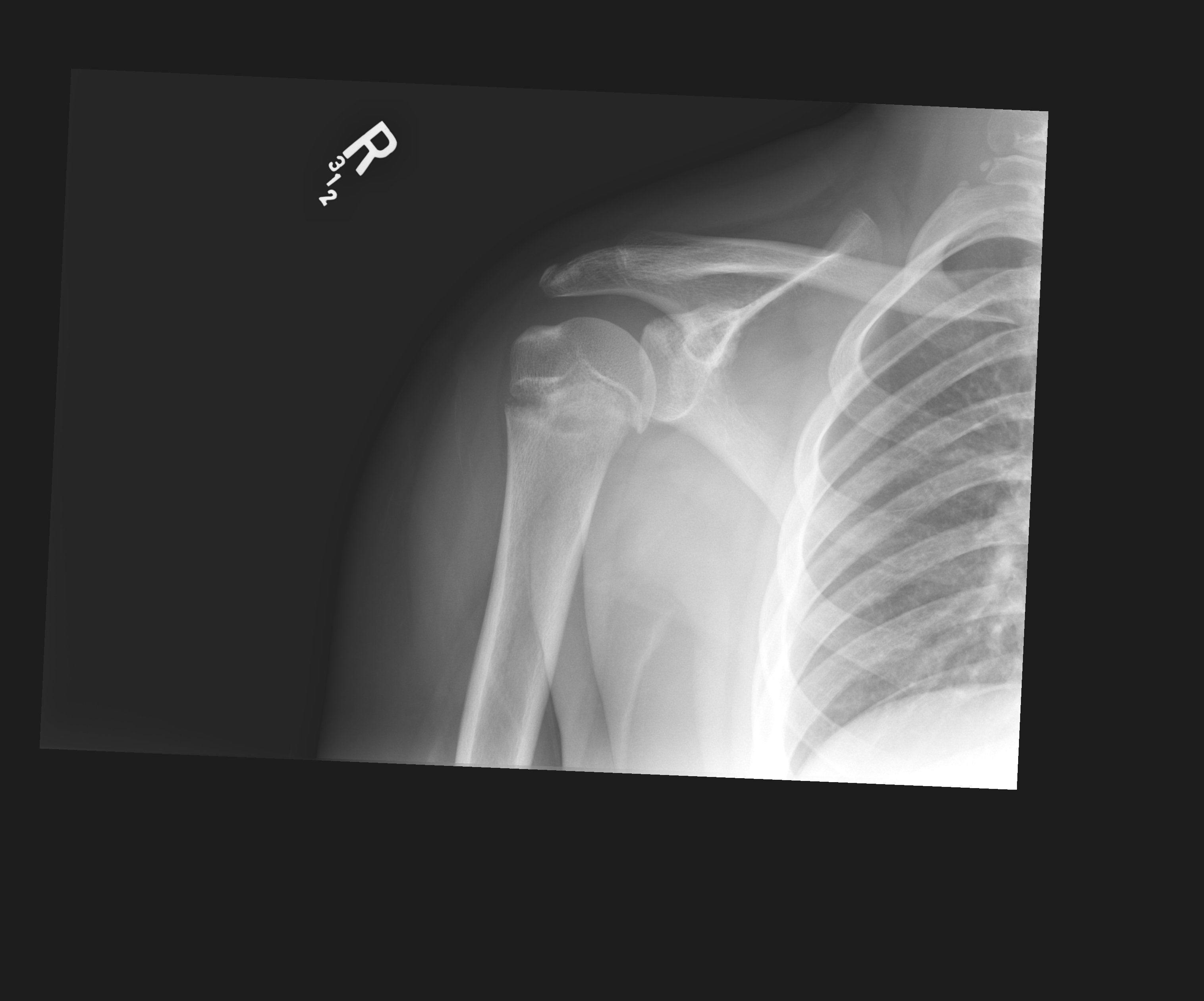 Radiograph of a right shoulder