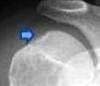 An Extremely Specific Sign of an Anterior Shoulder Dislocation