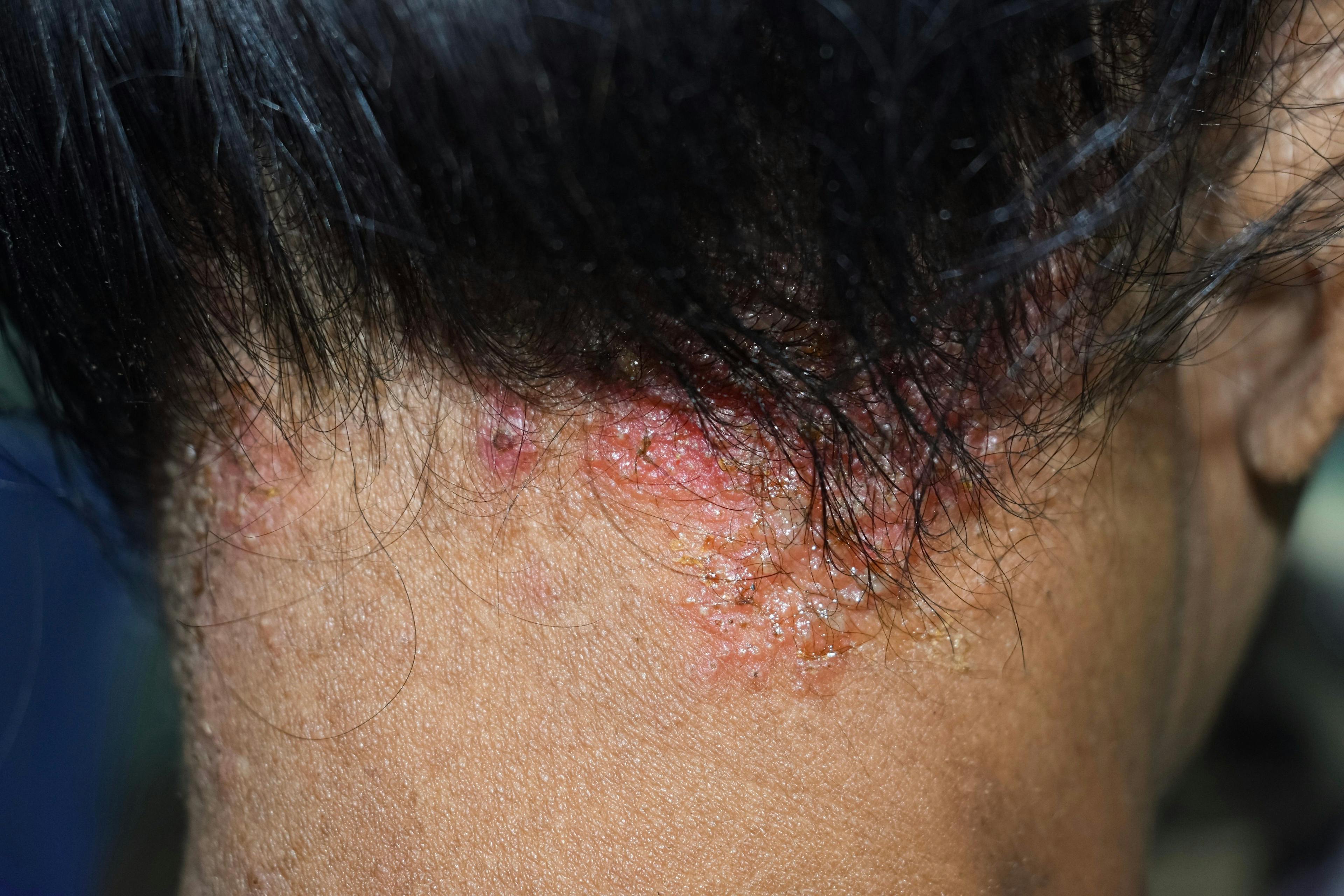 FDA accepts NDA for roflumilast foam 0.3% for seborrheic dermatitis | Image Credit: © ZayNyi - © ZayNyi - stock.adobe.com