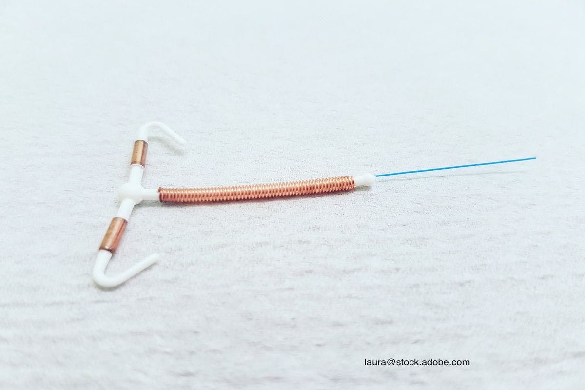 TikTok trends: Does IUD insertion hurt?