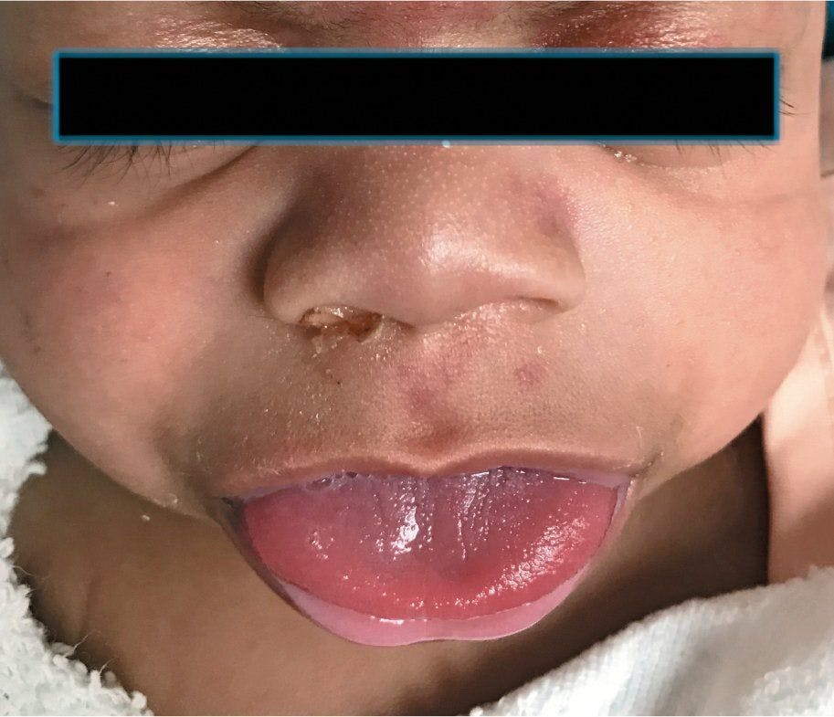 Macroglossia and capillary nevus flames on the glabella of this infant