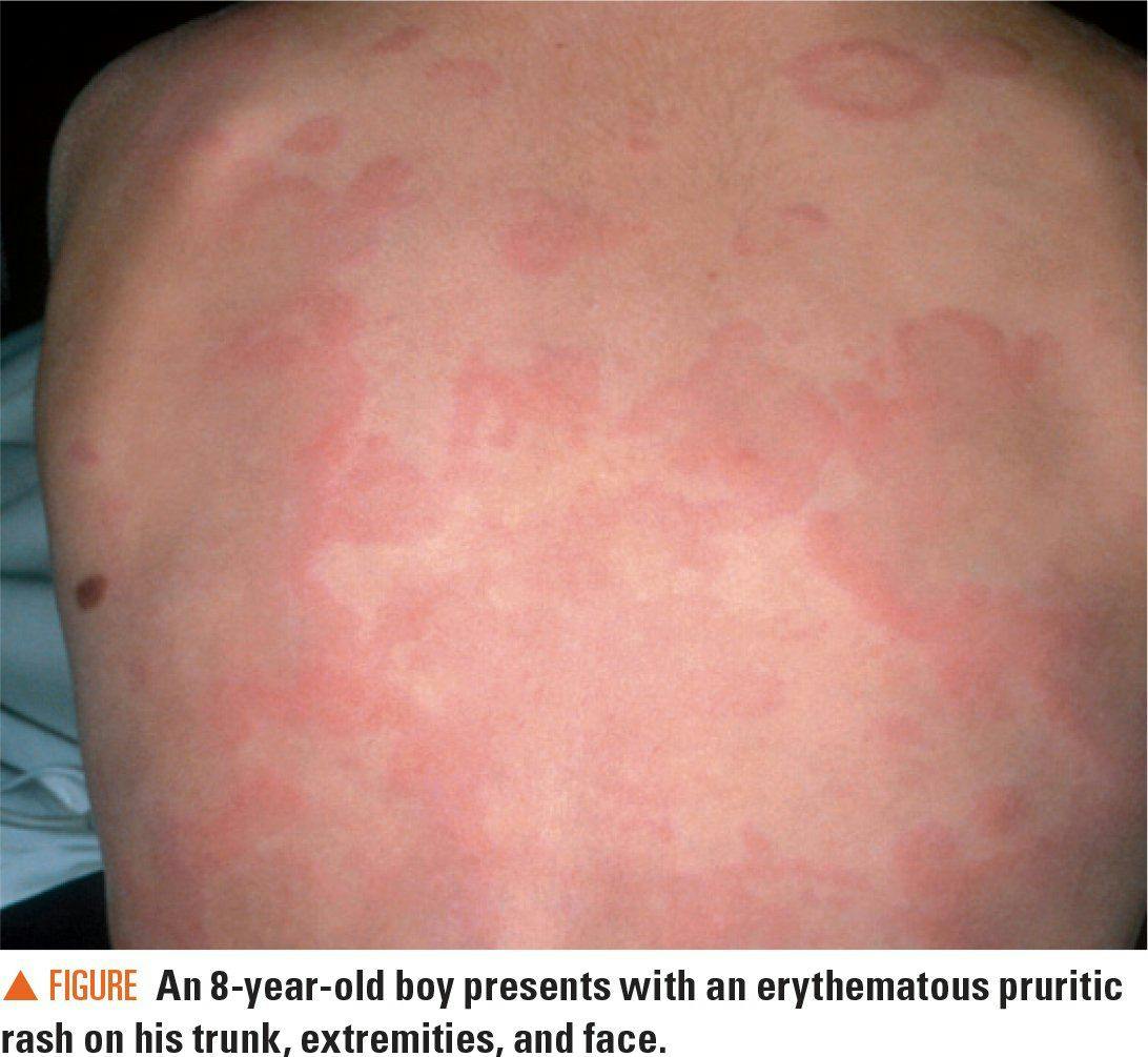 An erythematous pruritic rash