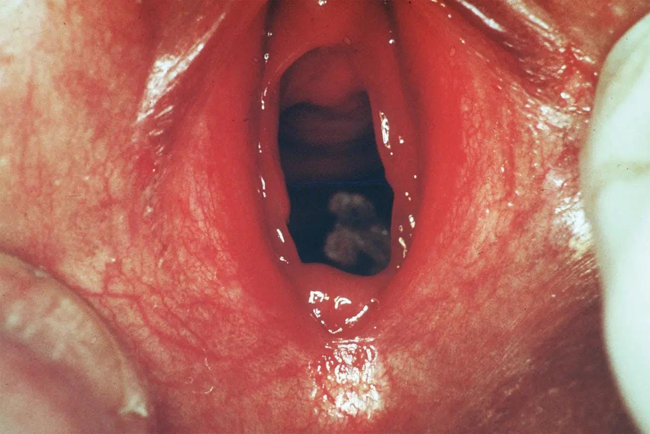FIGURE 2. Toilet paper within the vagina of a prepubertal child. (Reported in: Emans SJ, et al. Emans, Laufer, Goldstein’s Pediatric & Adolescent Gynecology. 7th ed. Figure 14-5, page 185, Philadelphia, Wolters Kluwer, 2020).