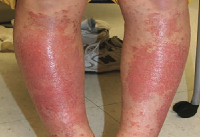 A case of shin guard dermatitis?