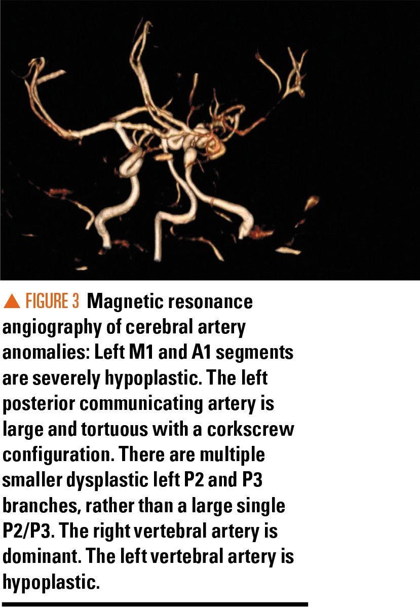 MRI of cerebral artery anomalies