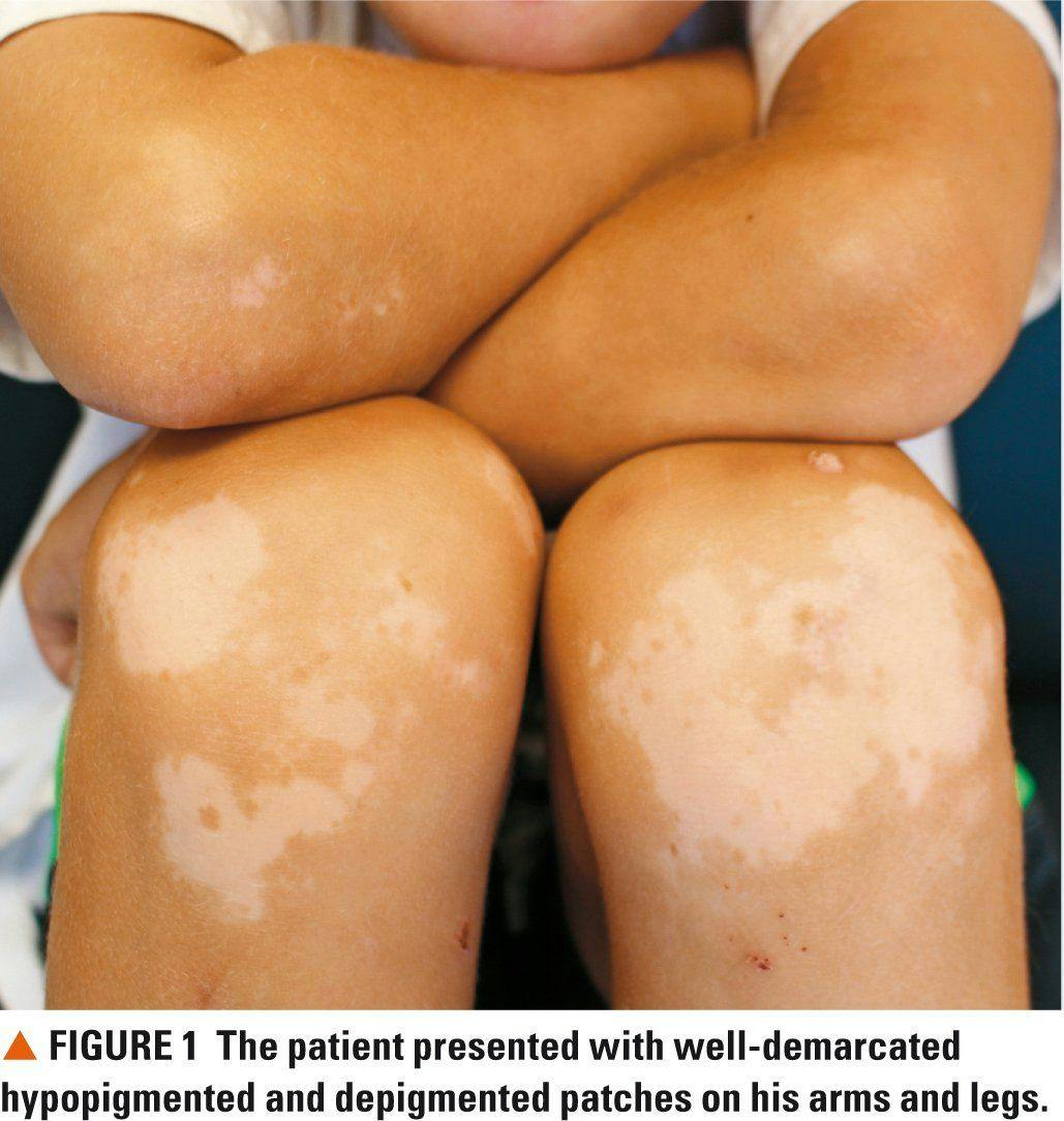 Figure 1. The patient presented with well-demarcated hypopigmented and depigmented patches on his arms and legs.