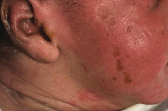 Diffuse erythematous rash in a healthy, afebrile infant