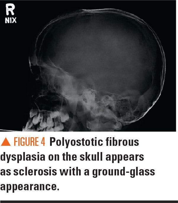 Polyostic fibrous dysplasia on the skull