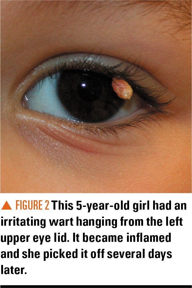 Girl with wart on upper eye lid