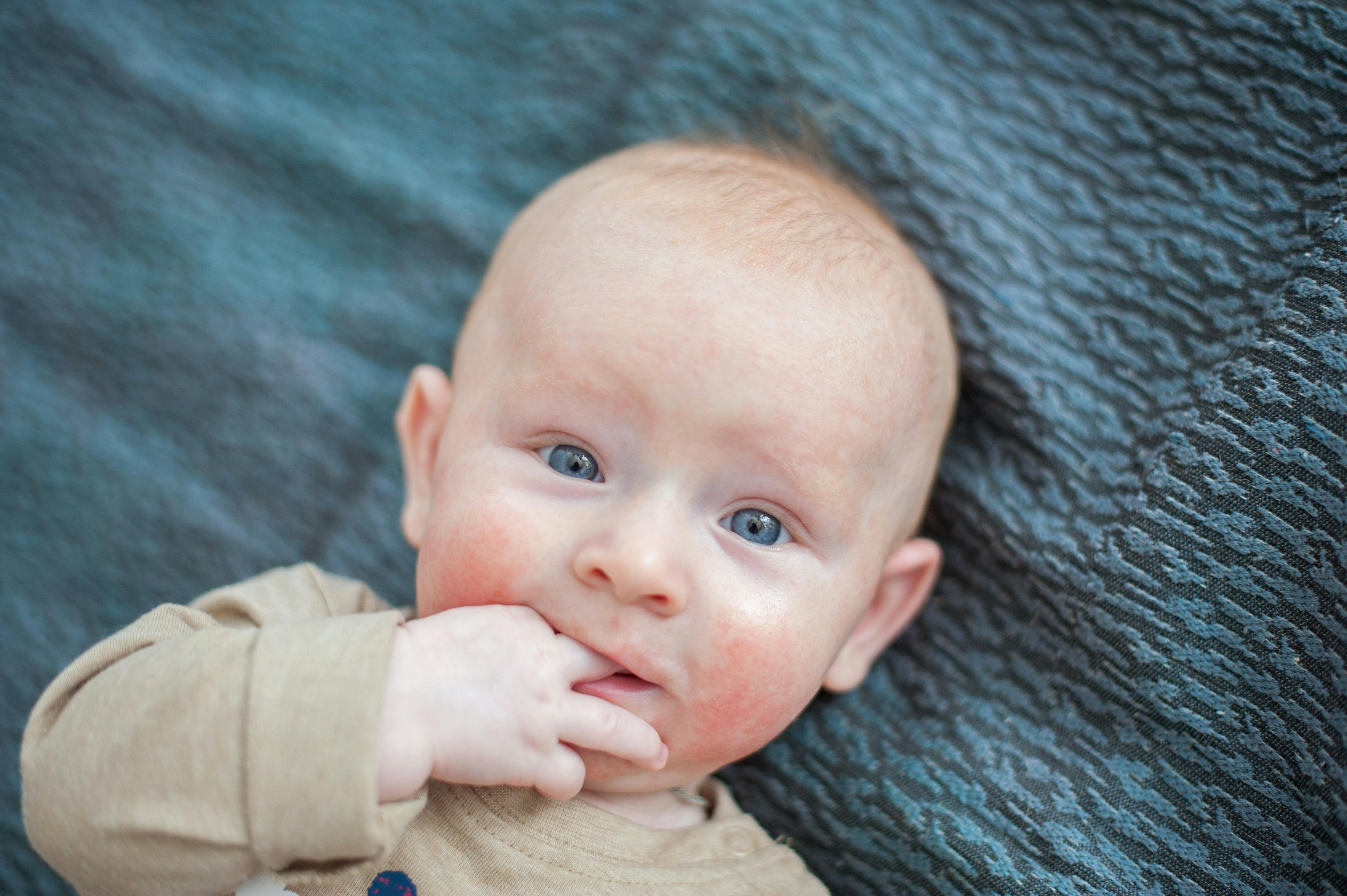 Skin eruptions on infants: self-resolving or concerning?