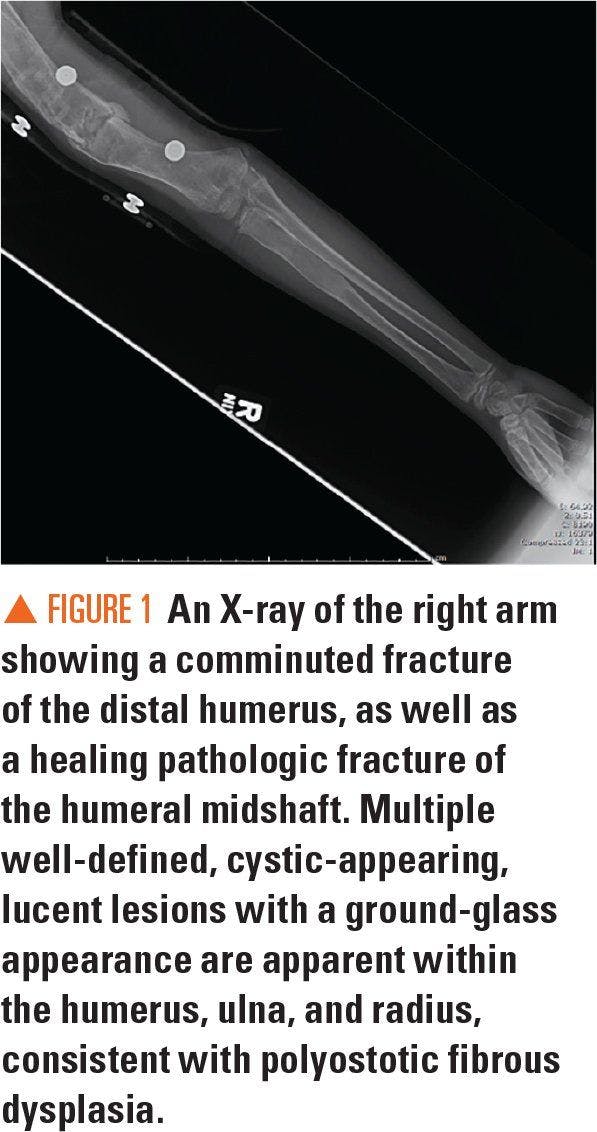 An x-ray of the patient's right arm showing a comminuted fracture
