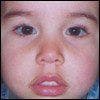 Osteogenesis Imperfecta in a 3-Year-Old Boy
