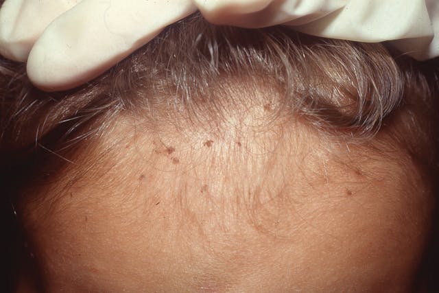 The Dx and Tx of head lice | Image Credit: Author provided