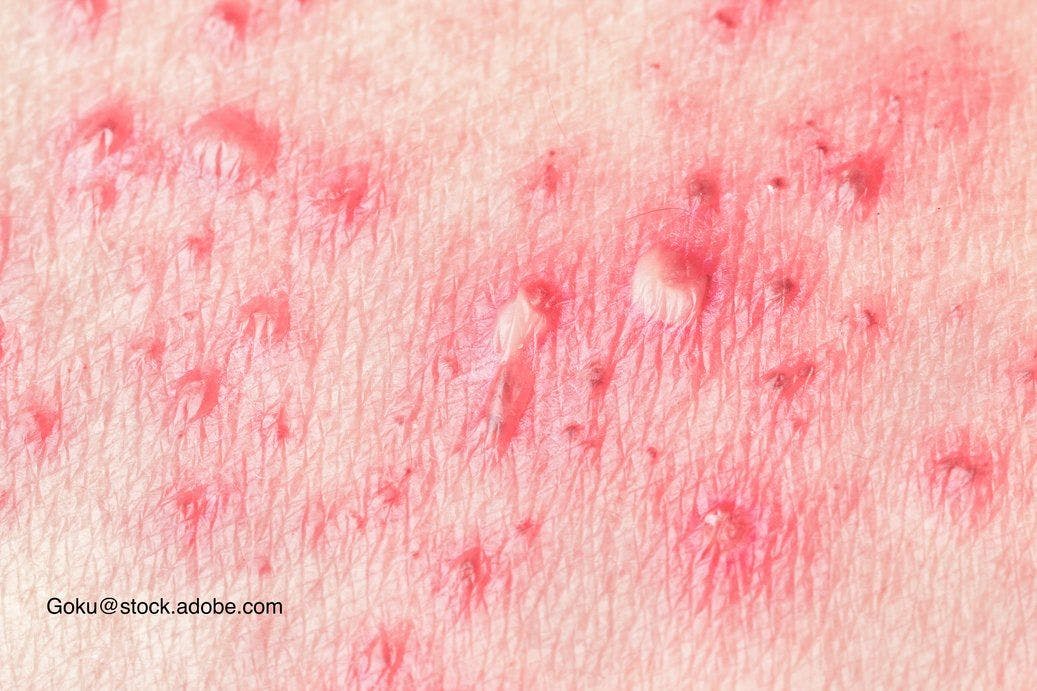 image of herpes zoster