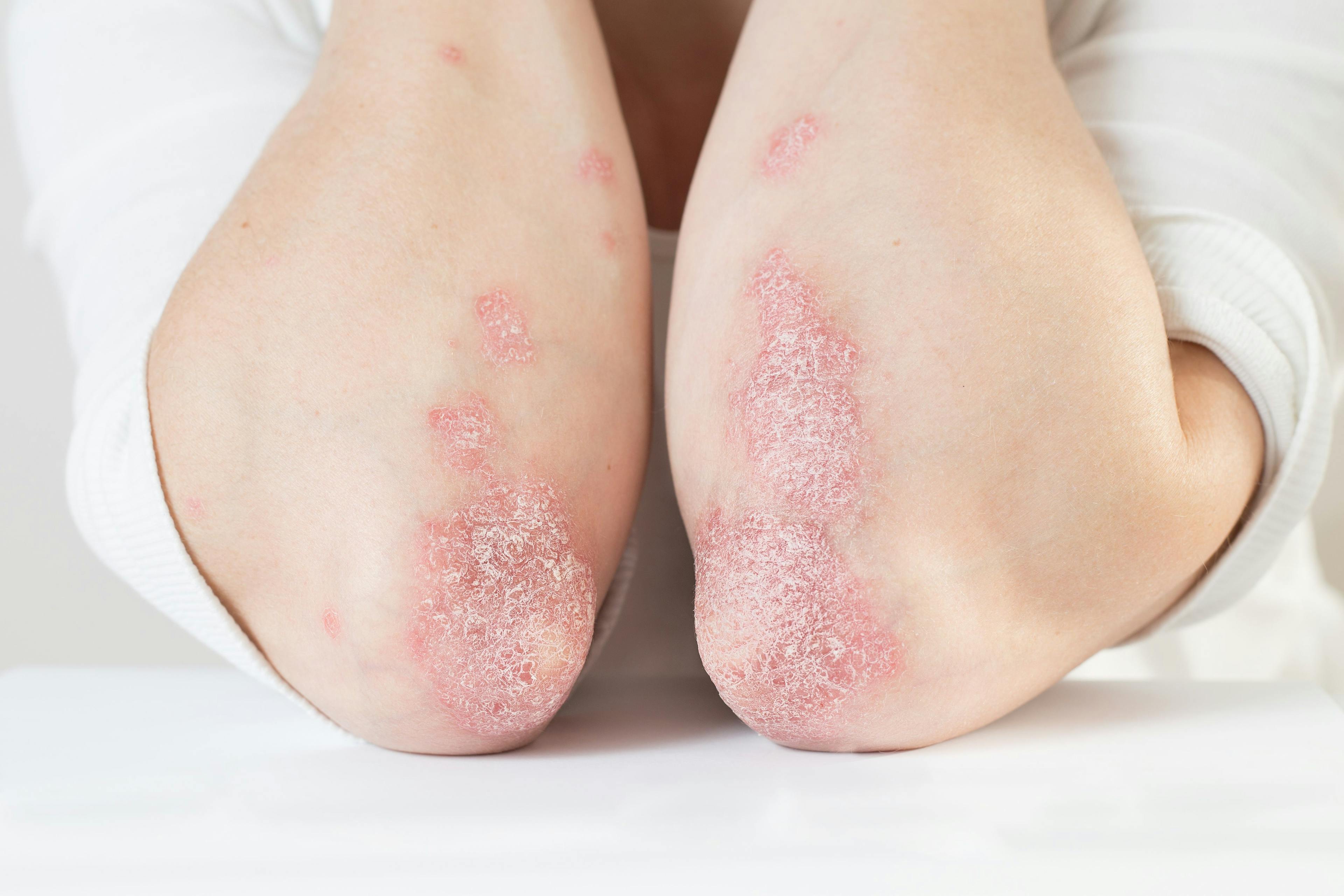 Apremilast demonstrates safety, efficacy in phase 3 trial for psoriasis in pediatric patients