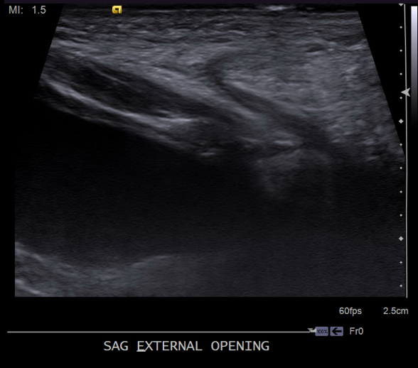Sagittal image of the bladder