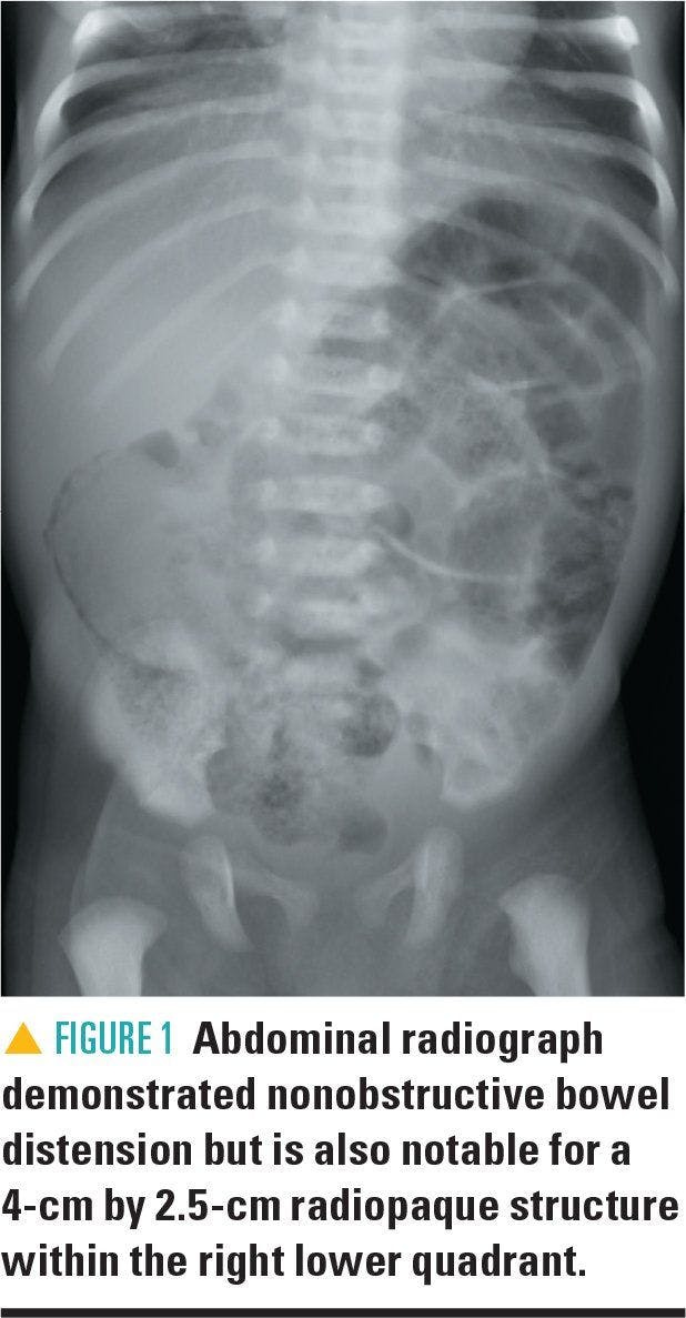 abdominal radiograph demonstrating nonobstructive bowel distension
