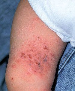 What Caused Eczema to Flare in This Toddler?