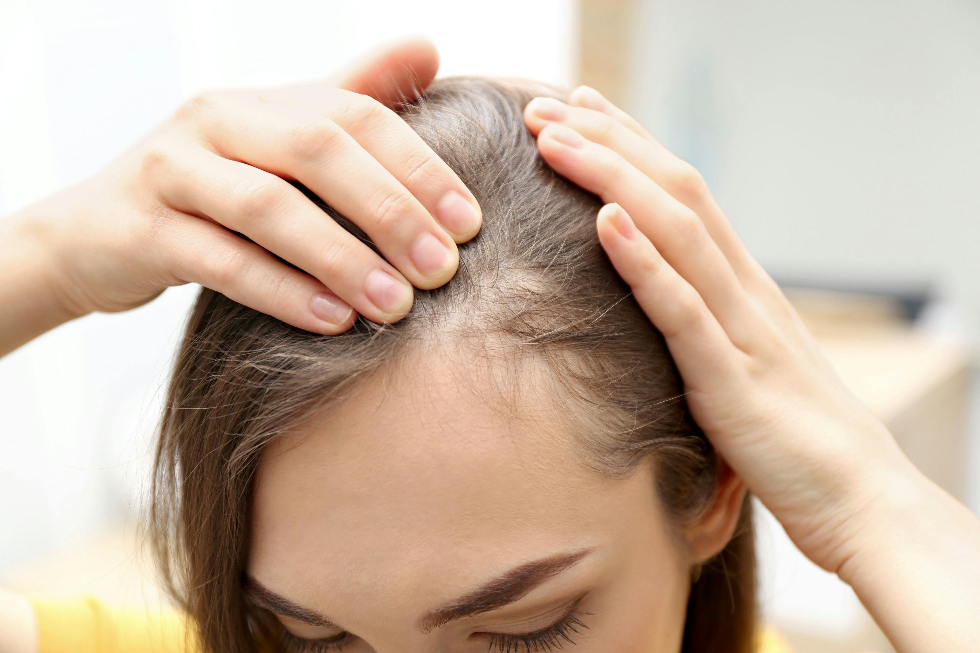 Higher risk of autoimmune, other disorders associated with children of mothers with alopecia areata | Image Credit: © New Africa - © New Africa - stock.adobe.com.