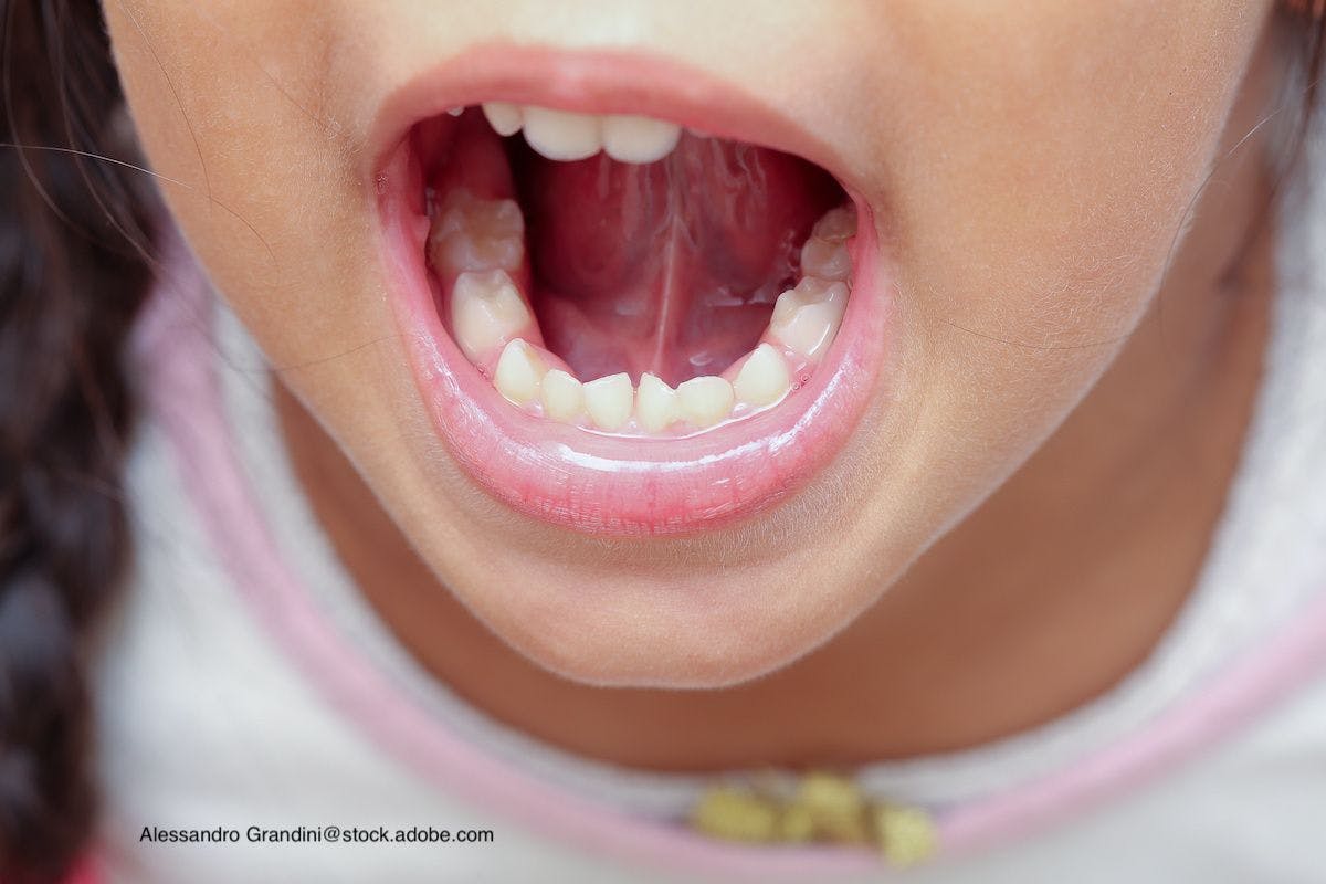 Considering oral care in children with special health care needs