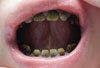Green Teeth in a Child With Hyperbilirubinemia