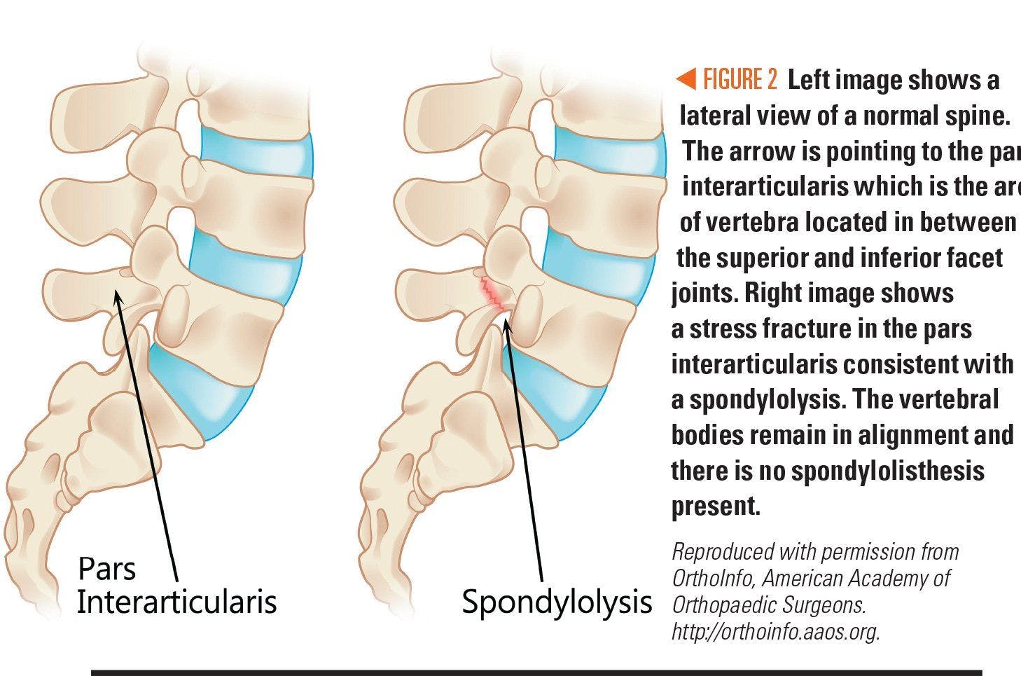Image of spine showing spondylolysis