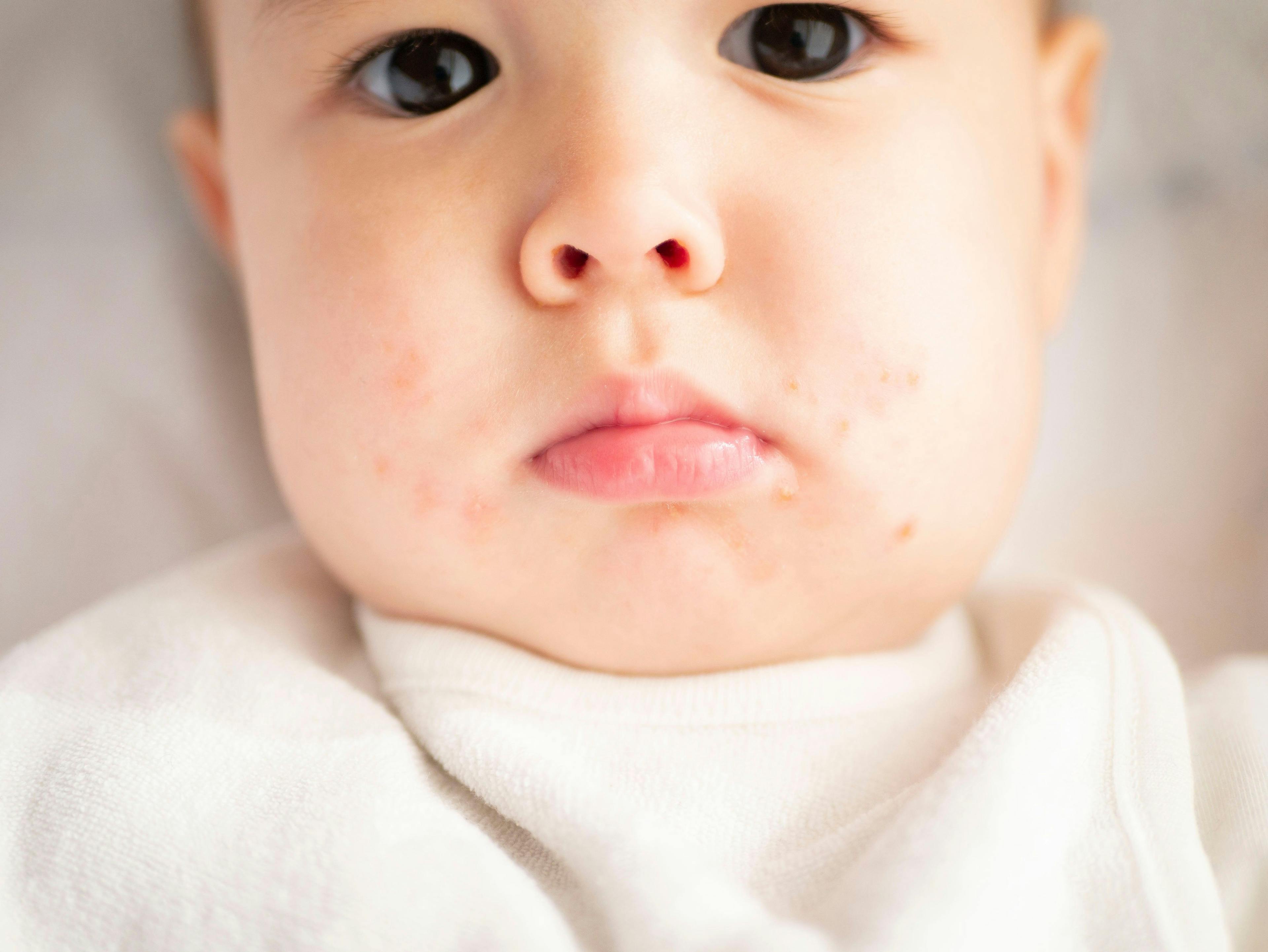 Pediatric Dermatology Cases: What's the Diagnosis?