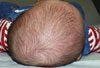 Positional Plagiocephaly, Part 1:A Practical Guide to Evaluation