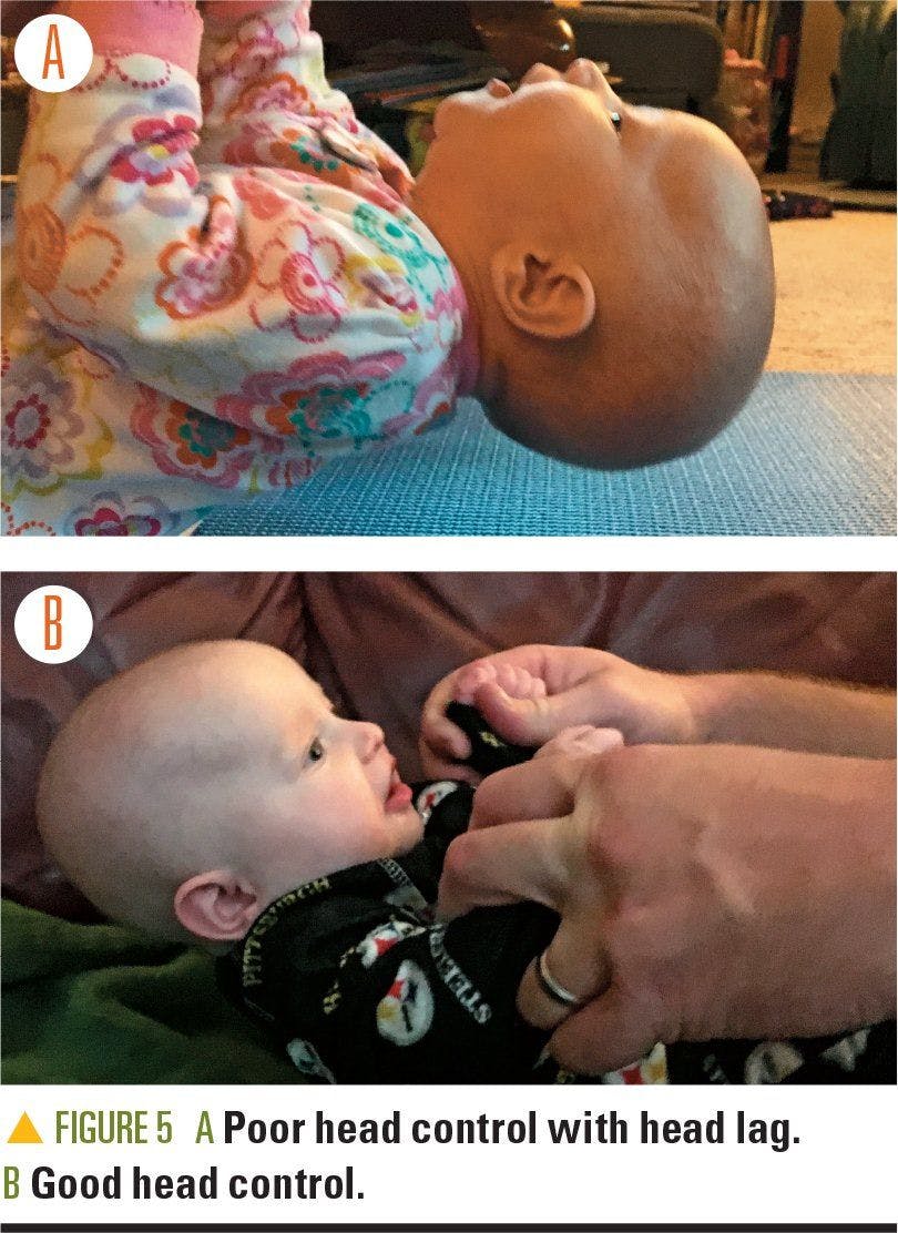 Baby with poor head control with head tag and a baby with good head control