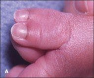 Congenital Bilateral Thumb Duplication