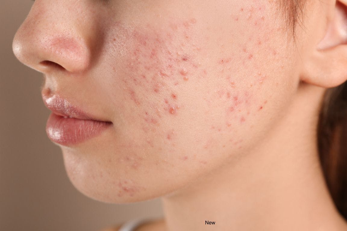 How pediatricians and dermatologist vary in acne treatment