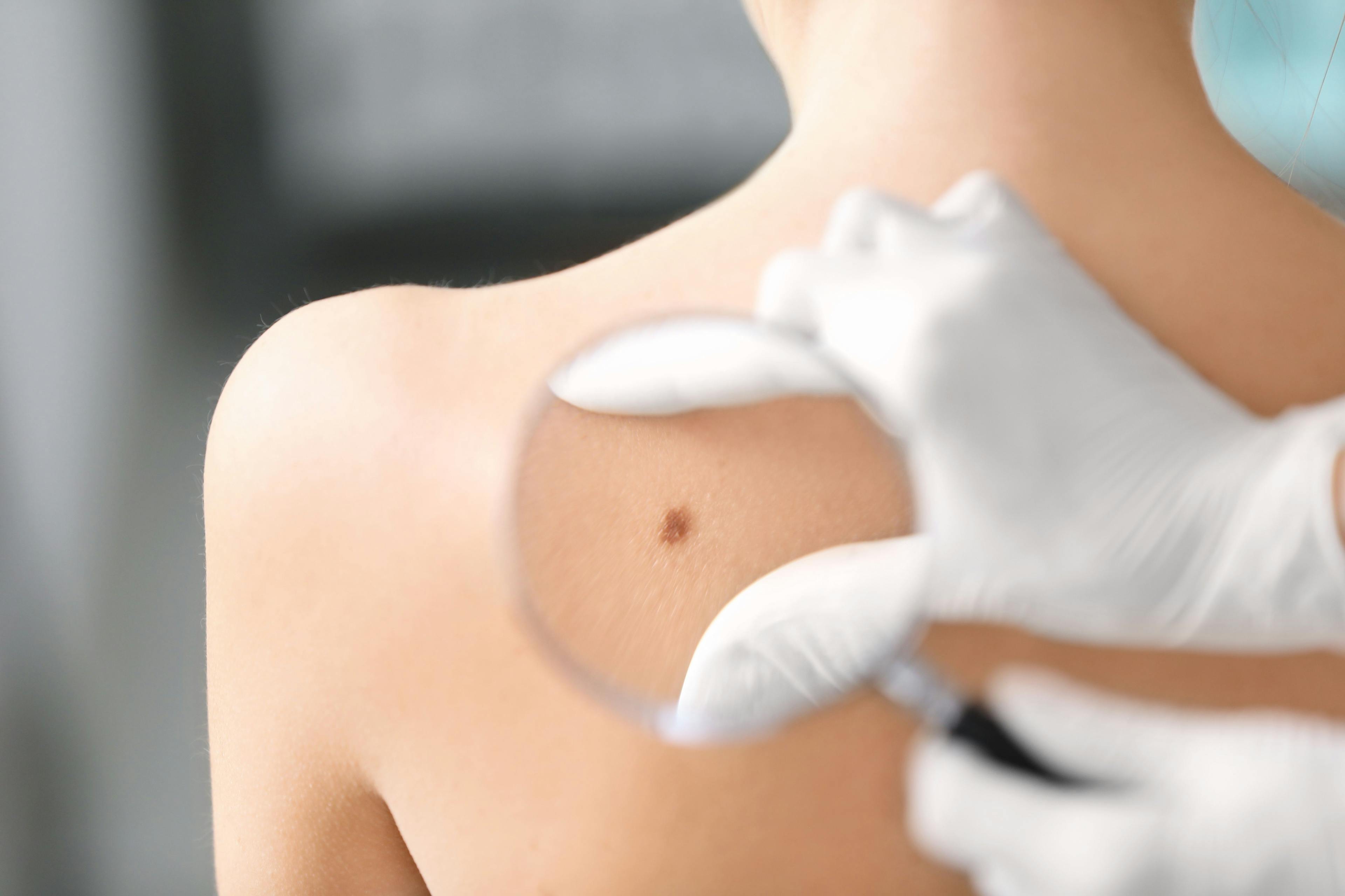 Updated recommendations on skin cancer screening