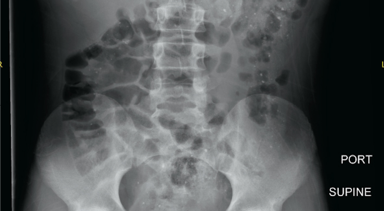 Child with punctate opacities in the colon
