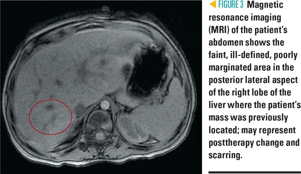 MRI of the patient's abdomen