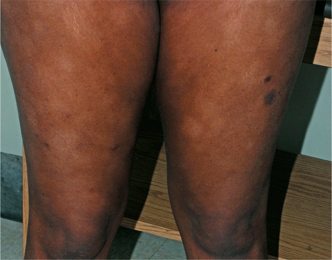 Hypopigmented lesions in a teenaged girl