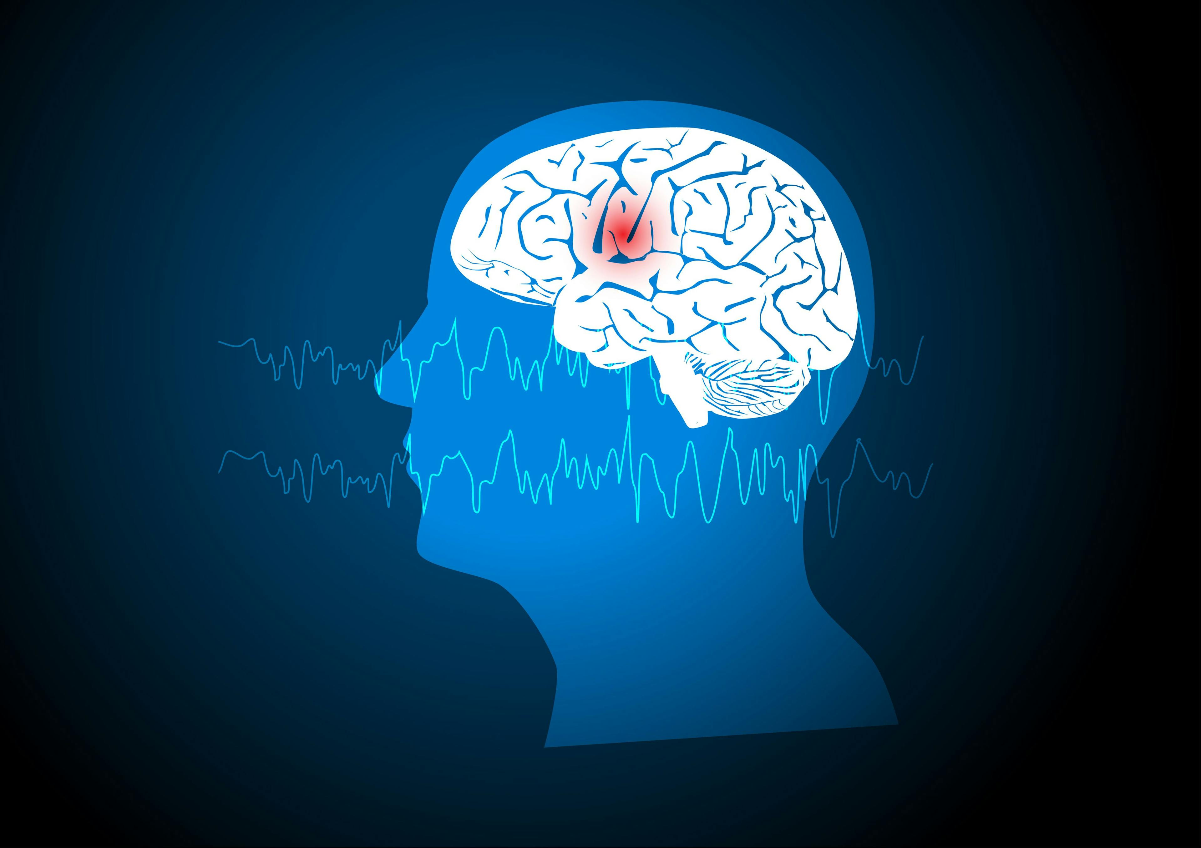 Concepts of human focal seizure or epilepsy | Image Credit: © Teeradej - © Teeradej - stock.adobe.com.