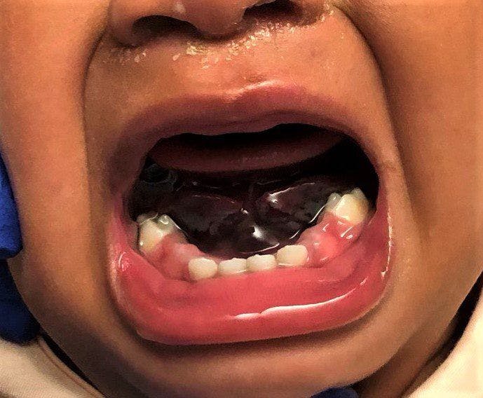 Repeat exam showed sublingual swelling on both sides of the frenulum with a dark purplish hue.