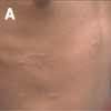 Pityriasis Rosea in a 7-Year-Old Girl