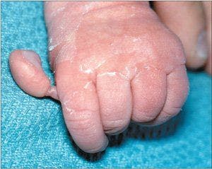 Polydactyly of the Hands and Feet