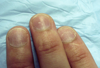 Twenty-Nail Dystrophy (or “Sandpapered Nails”)