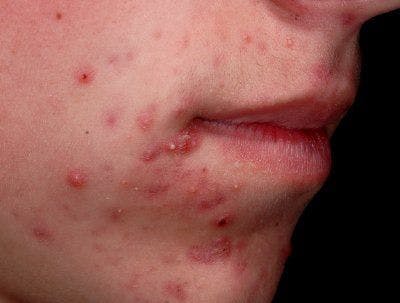 Is topical therapy the best choice for this teenaged boy’s acne?