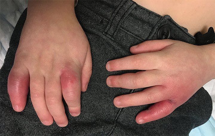 Erythematous swelling of the fingers after prolonged exposure to cold